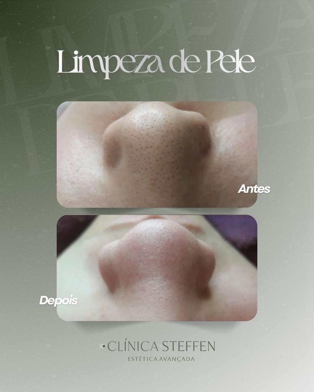 Limpeza de Pele Profunda